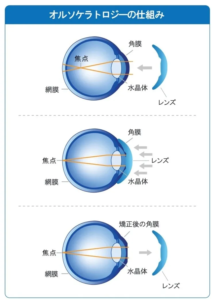 オルソケラトロジーとは