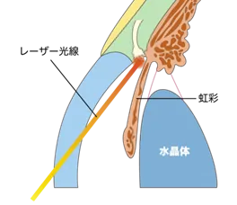 SLT（選択的レーザー線維柱帯形成術）